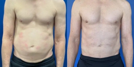 before after photo liposuction