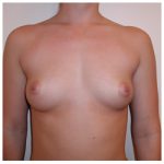 Breast Augmentation Before & After Patient #288