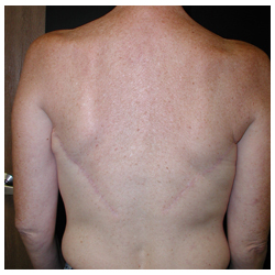 Latissimus Flap Breast Reconstruction Before & After Patient #462