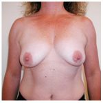 Breast Lift & Augmentation Before & After Patient #351