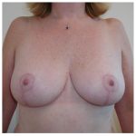 Breast Lift Before & After Patient #339