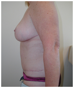 Breast Lift Before & After Patient #339