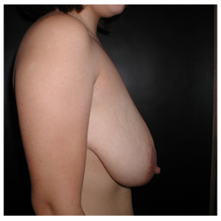 Breast Lift Before & After Patient #393