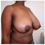 Breast Reduction Before & After Patient #371