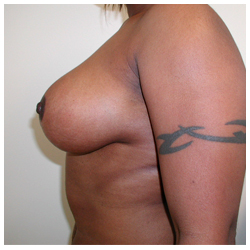 Breast Reduction Before & After Patient #371
