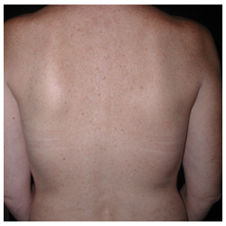 Latissimus Flap Breast Reconstruction Before & After Patient #462