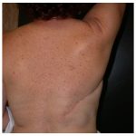 Latissimus Flap Breast Reconstruction Before & After Patient #469