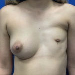 Poland Syndrome Before & After Patient #2122
