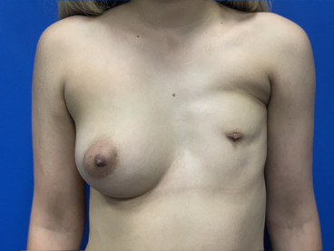 Poland Syndrome Before & After Patient #2122