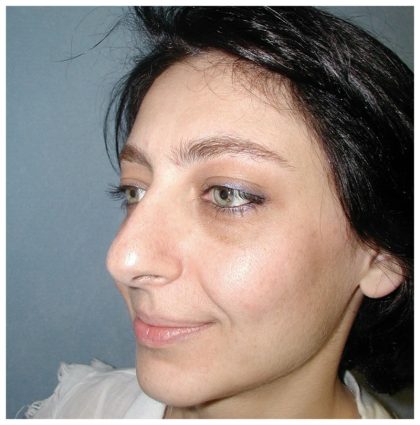 Rhinoplasty Before & After Patient #1007