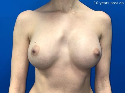 Breast Asymmetry Correction Before & After Patient #1815