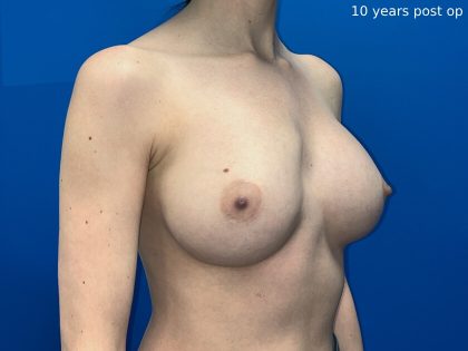 Breast Asymmetry Correction Before & After Patient #1815