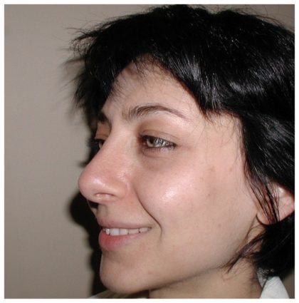 Rhinoplasty Before & After Patient #1007