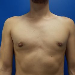 Gynecomastia Before & After Patient #2065