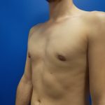 Gynecomastia Before & After Patient #2065