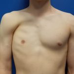 Poland Syndrome Before & After Patient #2127