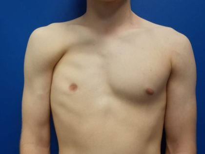Poland Syndrome Before & After Patient #2127