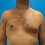 Poland Syndrome Before & After Patient #2128