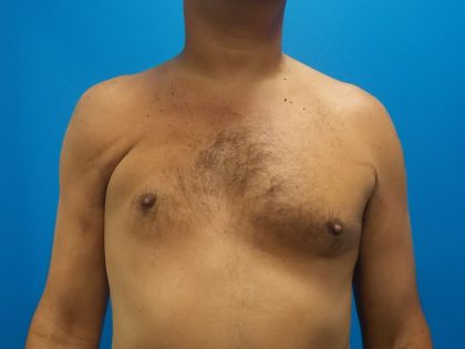 Poland Syndrome Before & After Patient #2128