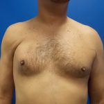 Poland Syndrome Before & After Patient #2128