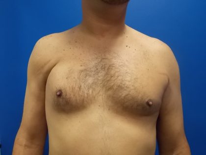 Poland Syndrome Before & After Patient #2128