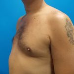 Poland Syndrome Before & After Patient #2128