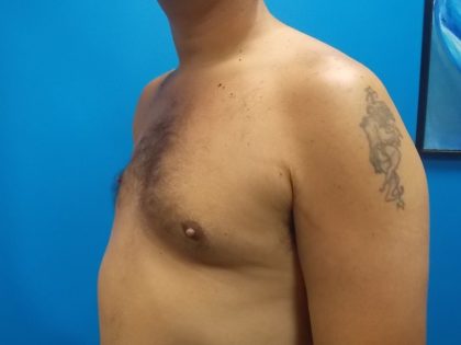 Poland Syndrome Before & After Patient #2128