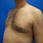 Poland Syndrome Before & After Patient #2128
