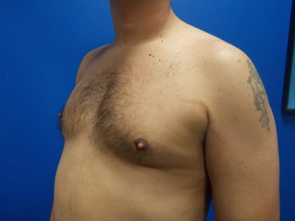 Poland Syndrome Before & After Patient #2128