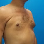 Poland Syndrome Before & After Patient #2128