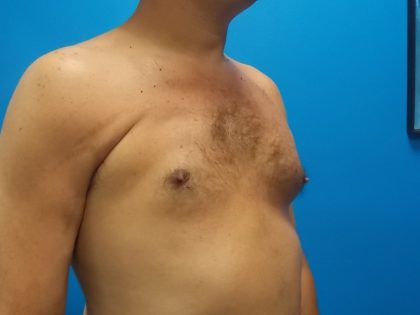 Poland Syndrome Before & After Patient #2128