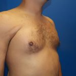 Poland Syndrome Before & After Patient #2128