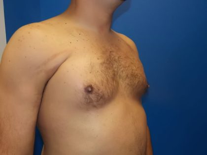Poland Syndrome Before & After Patient #2128