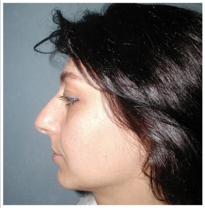 Rhinoplasty Before & After Patient #1007