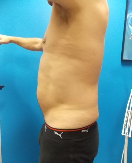 Liposuction Before & After Patient #2108