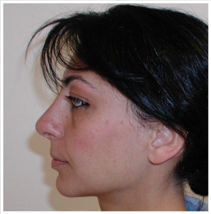 Rhinoplasty Before & After Patient #1007
