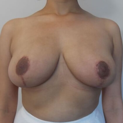 Breast Reduction Before & After Patient #2069