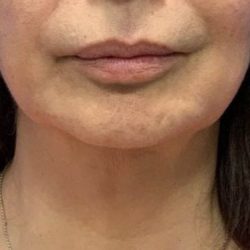 Submental Liposuction Before & After Patient #2088