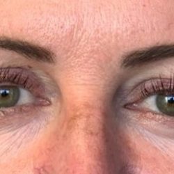 Lower Blepharoplasty Before & After Patient #2090