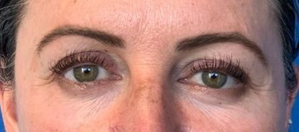 Lower Blepharoplasty Before & After Patient #2090
