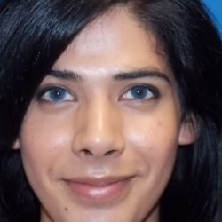 Rhinoplasty Before & After Patient #2135