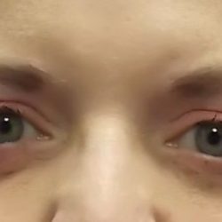 Upper Blepharoplasty Before & After Patient #2092