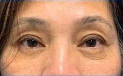 Lower Blepharoplasty Before & After Patient #2091