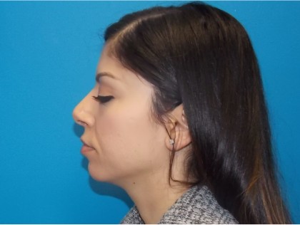 Rhinoplasty Before & After Patient #2136