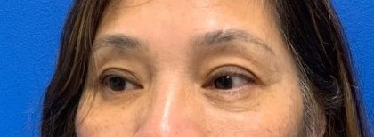 Lower Blepharoplasty Before & After Patient #2091