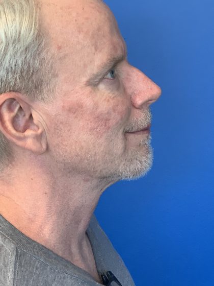 Chin Implant Before & After Patient #2057