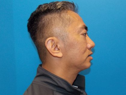 Chin Implant Before & After Patient #2278