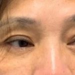 Lower Blepharoplasty Before & After Patient #2091
