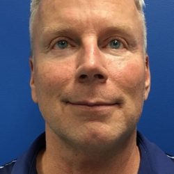 Chin Implant Before & After Patient #2057