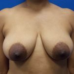 Breast Lift & Augmentation Before & After Patient #2044